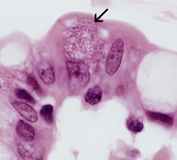 Microsporidiose